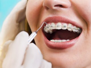 歯の矯正で医療費控除を利用する場合の手続きって？