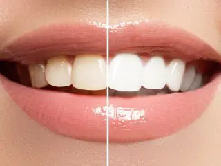 きれいな人がうらやましい…自分も「歯」を白くしたい！ どこまでが保険適用？