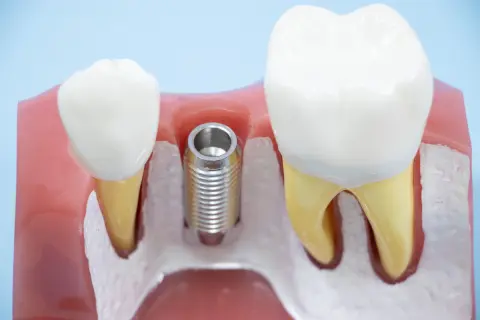 昨年末に受けたインプラント、保険適用外で「40万円」も負担したけど「医療費控除」の対象にはなる？ “歯科ローン”を組んで返済中なのですが、「確定申告」をすれば“還付金”を受け取れますか？