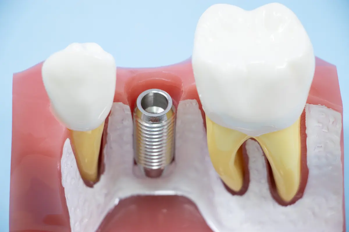 昨年末に受けたインプラント、保険適用外で「40万円」も負担したけど「医療費控除」の対象にはなる？ “歯科ローン”を組んで返済中なのですが、「確定申告」をすれば“還付金”を受け取れますか？