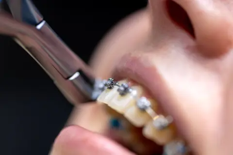 高校生の子どもが「歯列矯正」をしており、1年間で総額「40万円」かかりました。美容目的ではなく、噛み合わせ改善が目的ですが、この矯正費用は医療費控除の対象でしょうか？