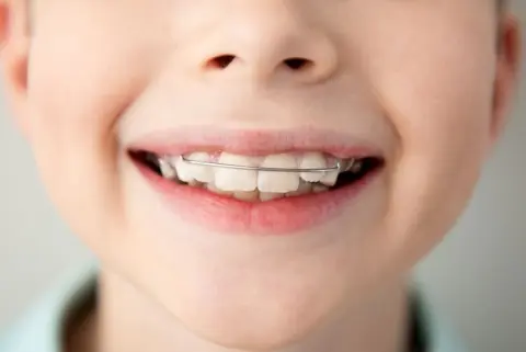 子どもの「矯正代」を“ボーナス100万円”で払う予定です。歯並びが悪く「見た目の改善」のためですが、審美目的でも“医療費控除”の対象になりますか？ 判断基準と具体例を確認